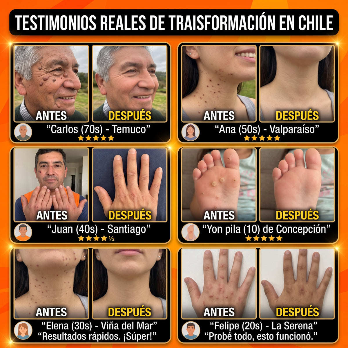 Crema Anti Verrugas