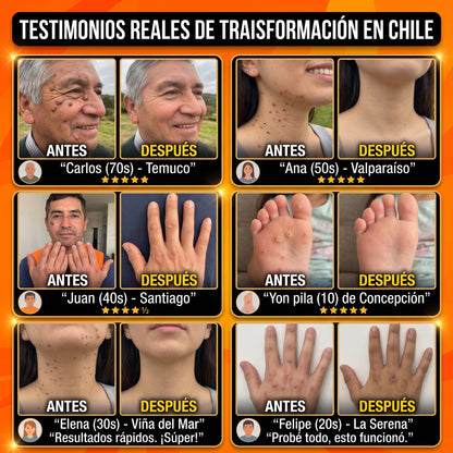 Crema Anti Verrugas